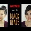 Acne: How to properly extract and prevent Blackheads